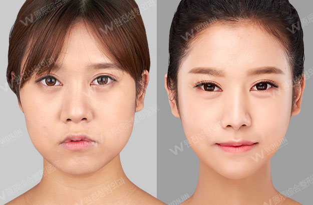 ウォンジンビューティーメディカルグループ 韓国整形 目 鼻 輪郭手術をした女性の症例写真 ウォンジンビューティーメディカルグループ 韓国整形 目 鼻 輪郭手術をした女性の症例写真