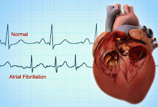 atrial fibrillation