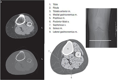 knee CT