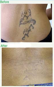 Tattoo Removal Methods