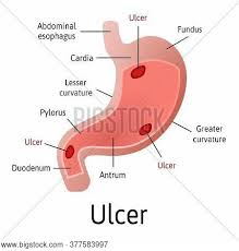 Stomach ulcers