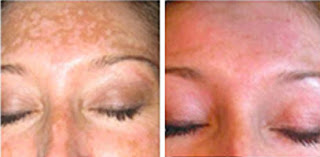 age spots before and after IPL