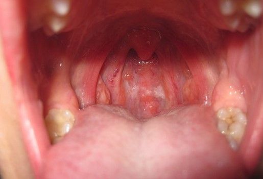 Bệnh viêm họng hạt là gì?