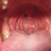 Viêm họng hạt: Dấu hiệu, biến chứng, cách phân biệt với viêm họng thường