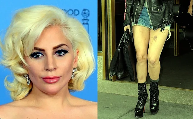 Lady Gaga sad and suspect bruised 