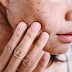 Recognize steroid infected skin when used on the skin for too long