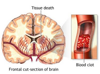 Obat herbal stroke di jogja, Diet Penyakit Stroke Pdf, Kti Penyakit Stroke, Terapi Mengobati Stroke Ringan, Pengobatan Stroke Otak, Cara Menyembuhkan Penyakit Stroke Berat, Obat Mujarab Penyakit Stroke, Cara Pengobatan Stroke Ringan, Tanaman Obat Herbal Stroke, Pengobatan Untuk Gejala Stroke, Penyakit Stroke Berat