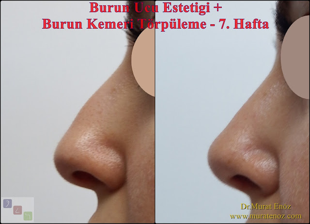 Rhinoplasty without bone breaking in Istanbul,Bruise after nasal hump removal,Nasal Hump Reduction,Nose Tip Plasty Istanbul,Nose tip lifting Turkey,