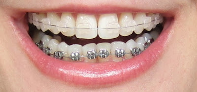 Phương pháp chỉnh nha niềng răng móm