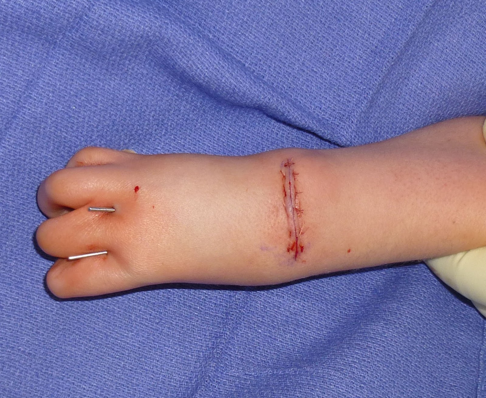 the wrist arthrogrypotic wrist before surgery arthrogrypotic wrist ...