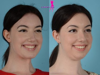 The Cheek and Chin Liposuction Procedur