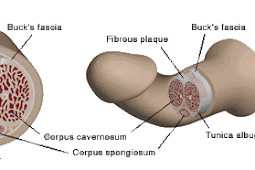 Penyakit Peyronie : Sebabkan Penis Bengkok