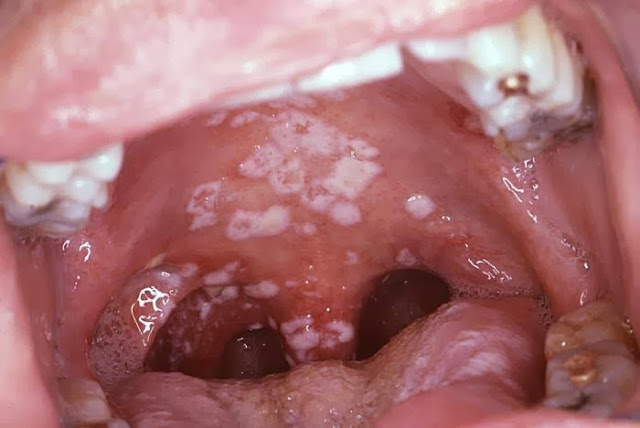 penyakit-kelamin-seks-bebas-virus-human-papilloma-vph-condylomes