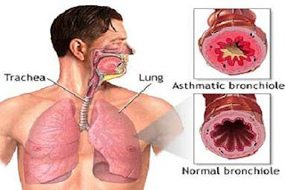 Reaksi Bronkus Pada Penyakit Asma