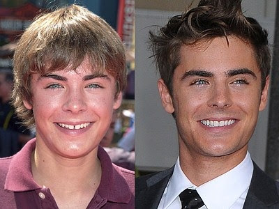 Zac Efron Before And After Veneers. Zac Efron