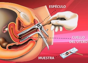 Imagen de un examen de Papanilocau a colores