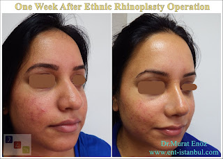 One Week After Ethnic Rhinoplasty Operation