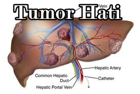 Obat Tumor Hati ini Ampuh Hilangkan Tumor Hati Tanpa Operasi