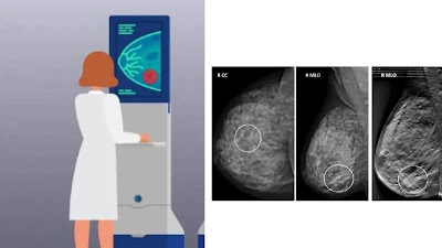 What is Mammography