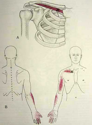 MIOTERAPIA