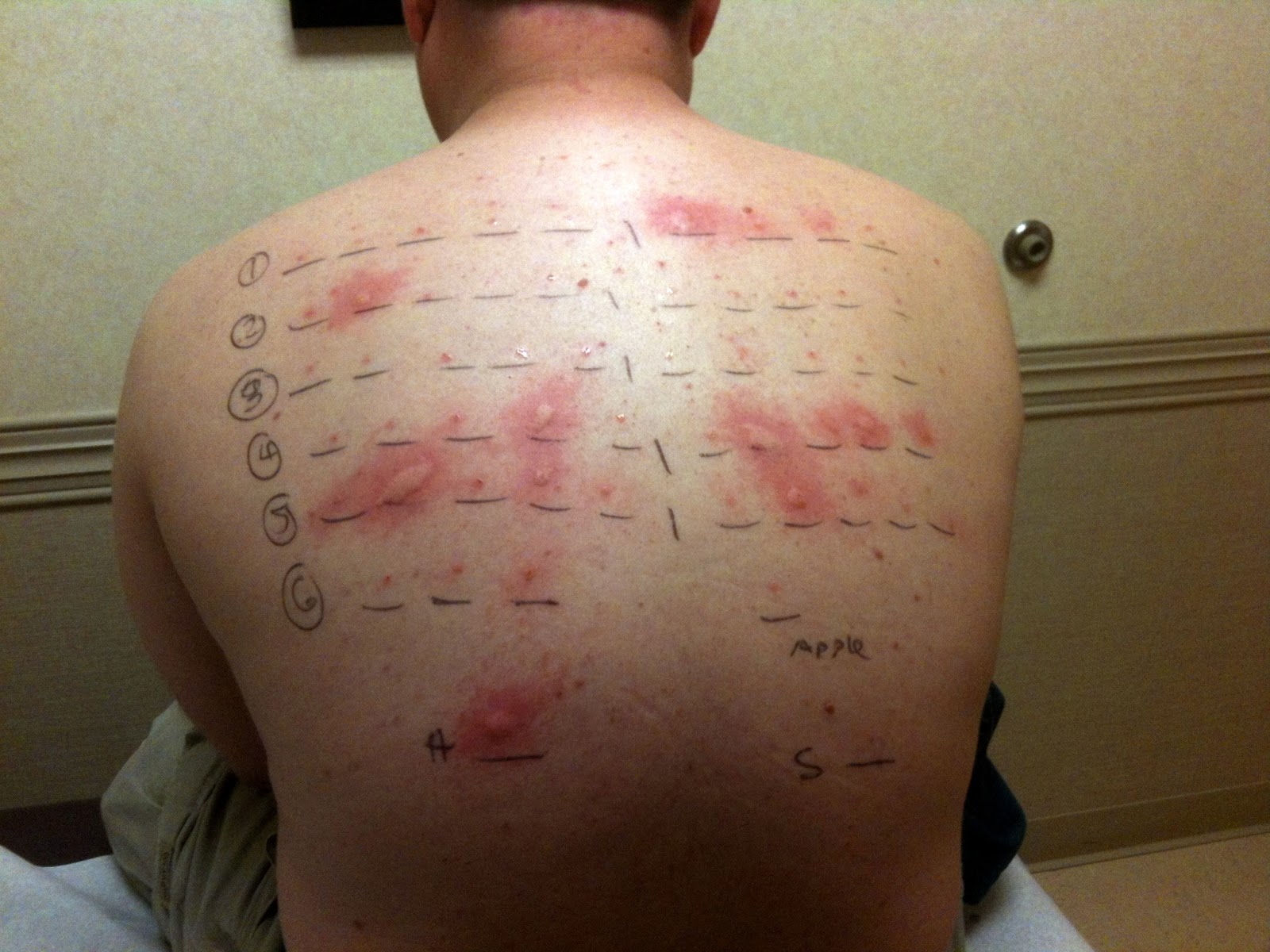 Hamburke Allergy Testing