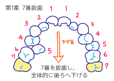 歯科矯正のイラスト　©さんがつの歯科矯正を始めます