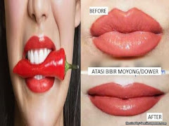 Pembedahan Menipiskan Bibir Jadi Trend Wanita Di Asia