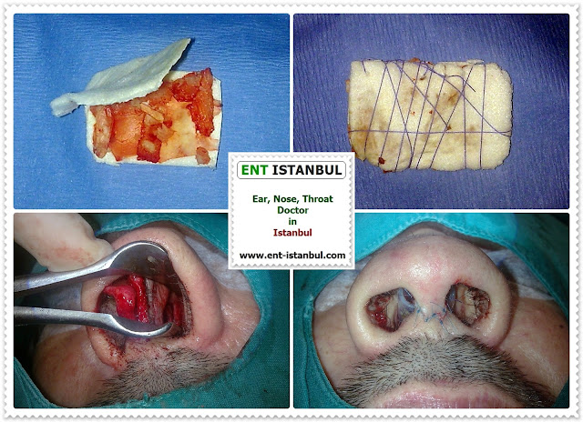 Definition of Nasal Septal Perforation - Causes of Perforated Nasal Septum - Symptoms of Nasal Septal Perforation - Diagnosis of Nasal Septal Perforation - Medical Treatment For Nasal Septal Perforation - Septal Button - Nasal Septal Perforation - Surgical Repair of Nasal Septal Perforation - Very Large Nasal Septal Perforations - Surgical Difficulty - Postoperative Patient Care After Nasal Septal Perforation Repair