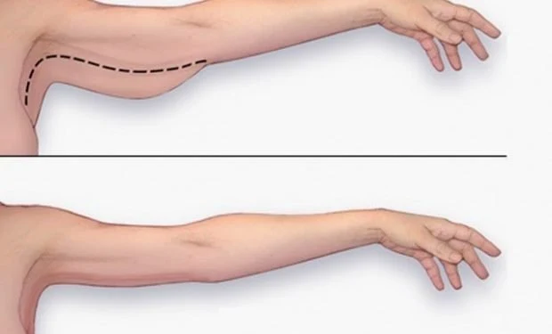 5 Exercises For Tonic  Arms