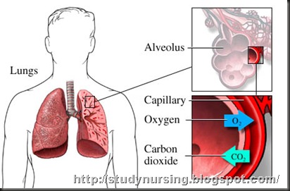 pleurisy
