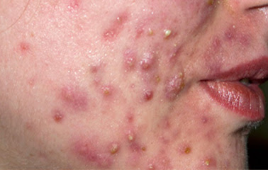 http://www.nhs.uk/tools/documents/visual_guides_v2/data/skin_problems/images/sc-acne.jpg