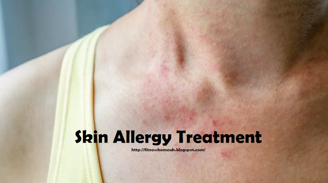 Skin Allergy Treatment