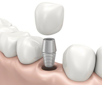 Trồng răng implant mất bao lâu thì hoàn tất? 2