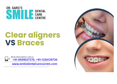 Dental Braces Treatment & Best Invisible Aligner Treatment