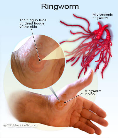 Mazlina domairi: Ringworm- fungal infection