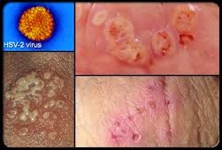 penyakit herpes genital penyakit herpes genital