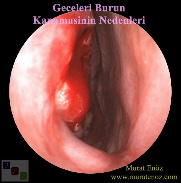 Geceleri burun kanaması nedenleri - Uykuda burun kanaması nedenleri - Uyurken burun kanaması nedenleri - Sol burun kanaması neden olur? - Çoçuklarda gece burun kanaması nedenleri - Tek taraflı burun kanaması nedenleri - Sağ burun kanaması neden olur - Burun kanamasından sonra uyunur mu? - Durduk yere burun kanaması - Burun kanaması nasıl durdurulur? - Sağ burun kanaması - Sol burun kanaması neden olur? - Uyurken aniden burun kanaması - Burun kanamasından sonra uyunur mu? - Tek taraflı burun kanaması - Düşme sonucu burun kanaması - Geceleri epistaksis nedenleri - Epistaksisin başlıca nedenleri - Evde burun kanaması nasıl durdurulur? - Geceleri burun kanaması nasıl önlenir?