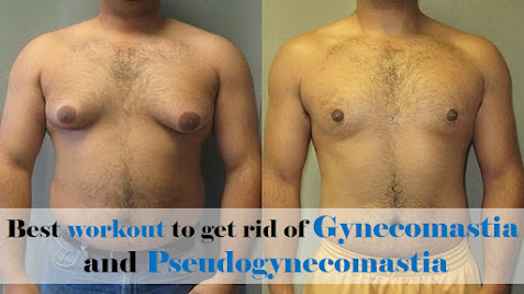 Best workout to get rid of Gynecomastia and Pseudogynecomastia: Gynecomastia and Pseudogynecomastia