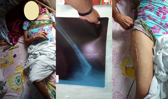 Moradora do Alto de São Sebastião clama por uma cadeira de rodas para poder se locomover