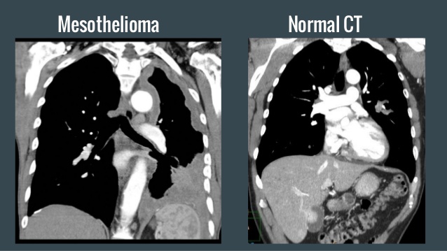 Mesothelioma Pictures