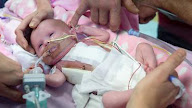 Lahir Dengan Jantung di Luar Tubuh, Bayi ini Tetap Selamat
