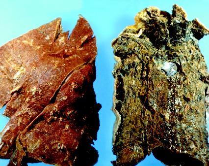 ~left lung before and after smoking lungs. ~left lung