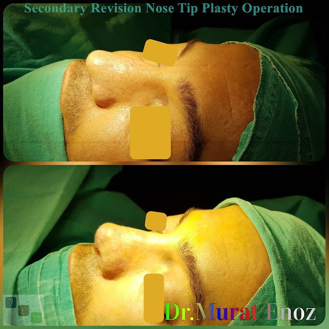Revision Nose Tip Plasty in Men Istanbul