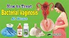 Bacterial Vaginosis Treatment | BV Treatment