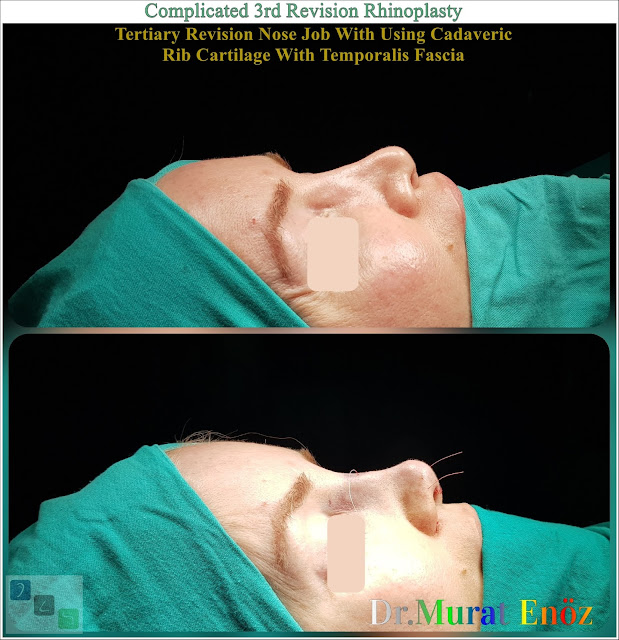 Complicated 3rd Revision Rhinoplasty - Tertiary Revision Nose Job With Using Cadaveric Rib Cartilage With Temporalis Fascia