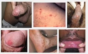 Sipilis raja singa Sipilis raja singa