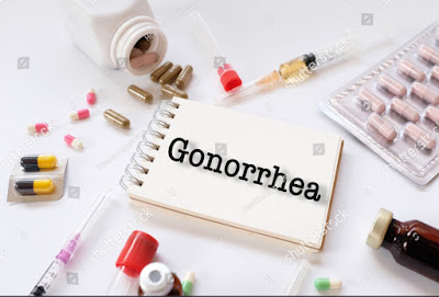 Gonorrhea