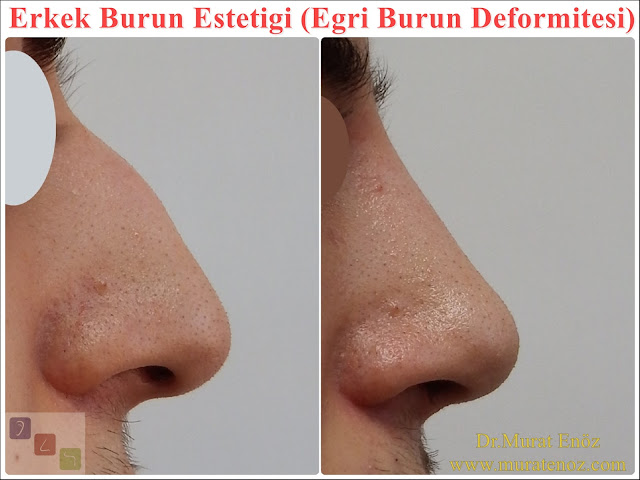 Crooked nose - Deviated nose - Twisted nose - Deflected nose - Asymmetric nose - Scoliotic nose - Eğri burun - C burun - S-shaped crooked nose deformity -  Rhinoplasty Istanbul - Rhinoplasty in Istanbul - Rhinoplasty Turkey - Rhinoplasty in Turkey – Rhinoplasty doctor in Istanbul – ENT doctor in Istanbul - Nose Job in Istanbul - Before and after rhinoplasty photos