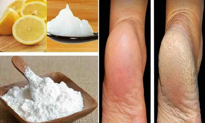 Causes of cracked foot and 4 recipes for treatment