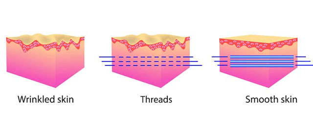 how do threadlifts work